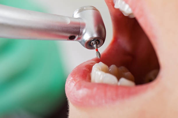 Best Emergency Tooth Extraction in Lenoir, NC